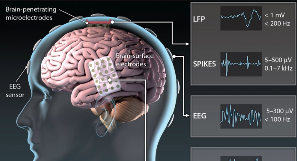 Diagrama anatómico de una interfaz cerebro-computadora que muestra electrodos cerebrales y señales neuronales registradas.